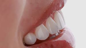 Top 5 Questions People Ask About Veneers
