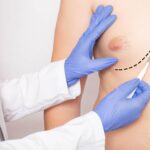 Gynecomastia-Surgery-in-Islamabad.jpg