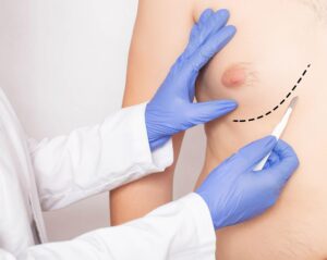 The Psychology of Male Breast Enlargement: How Gynecomastia Affects Confidence