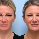 H25-botox.webp