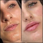H8-lip-fillers.jpg