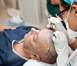 زراعة الشعر للرجال والنساء: التحديات والحلول الفعالة