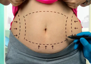 How Do I Know If I’m a Good Candidate for a Mini Tummy Tuck in Dubai?