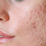 How-to-Treat-Acne-Scars-for-Clearer-Blemish-Free-Skin-3.jpg