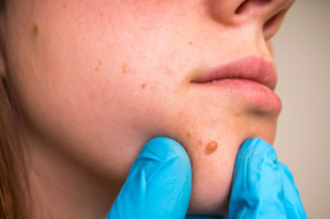 Is Skin Tag Removal Safe for the Face?