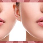 Lip-Reshaping-Treatments-Islamabad.jpg