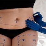 Liposuction-126.jpg