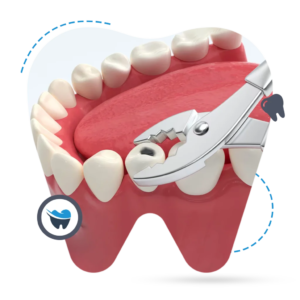 Root Canal vs. Teeth Extraction: A Clinical Comparison