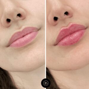 Juvederm Treatment in Dubai for Perioral Lines