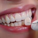 Veneers-for-a-flawless-smile.jpg