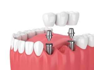What’s the Difference Between Ceramic, Zirconia, and Porcelain Crowns?
