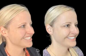 Where to Get Reliable Botox in Dubai
