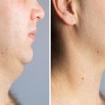 chin-reduction-Dubai25.jpg