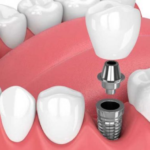 dental-gb-impianto-dentale.png