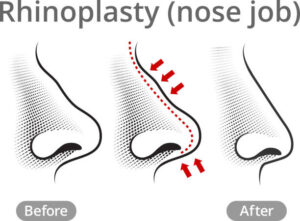 Rhinoplasty in islamabad near
