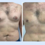 gynecomastia-in-dubai.jpg