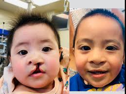 Comprehensive Guide to Cleft Lip and Palate Treatment in Islamabad