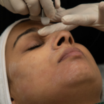 imageye___-_imgi_19_microdermabrasion.png