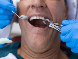 Teeth Extraction Milton | Smilelounge.ca