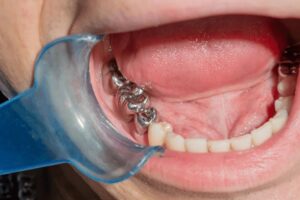 Restorative Dentistry Milton | Smilelounge.ca