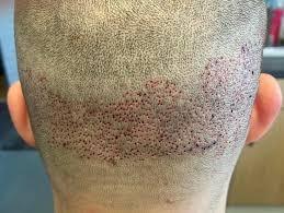 Do Male Hair Transplants Work on Crown Thinning?