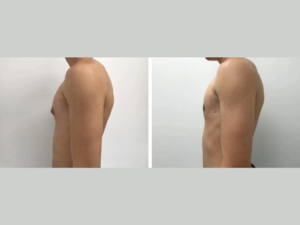 Navigating Gynecomastia Treatment with Islamic Values in Dubai