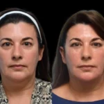 3-Dark-Circles-Treatment.webp