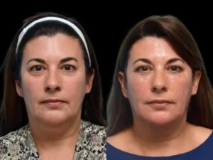 How Dark Circles Treatment in Dubai Can Revitalize Your Eye Area