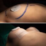 Breast-Reduction-in-Riyadh-15.jpg