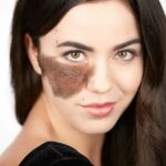 Can-Birthmark-Removal-Improve-Skin-Tone.jpg