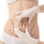 Can-Tummy-Tuck-Surgery-Remove-All-Belly-Fat.jpg