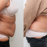 Can-You-Stand-Fully-Upright-After-a-Tummy-Tuck.png
