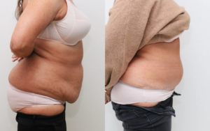 Tummy Tuck Pain Levels: What to Expect and How to Cope