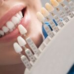 Dental-Veneers-in-Dubai.jpg