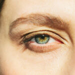 Eyelid-Surgery-in-Riyadh-21.jpg