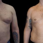H-Gynecomastia-2.jpg