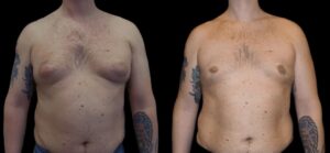 Gynecomastia Surgery in dubai: Patient Success Stories