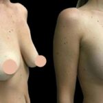 H11-Breast-Augmentation-ezgif.com-webp-to-jpg-converter.jpg