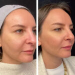 H3-Mesotherapy-1.jpg