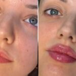 H5-lip-fillers-1-1-780x470.jpg