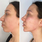 H6-Endolift.jpg