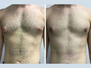 Gynecomastia Surgery in Dubai for Grade 1 to 4 Cases
