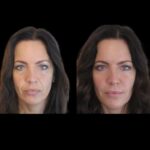 H7-Jawline-Fillers.jpg