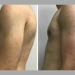 H9-Gynecomastia-1.jpg