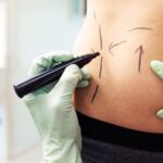 How-Soon-Can-I-Return-to-Work-After-Abdominal-Liposuction-in-Dubai.jpg