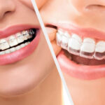 Invisalign-Vs-braces-1024x683-1.jpg