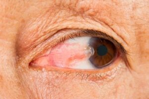 What to Know About the Price for Laser Eye Surgery UK?