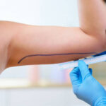 Liposuction-surgery-in-Riyadh-33.jpg
