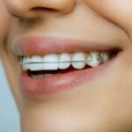 Retainers-help-maintain-your-perfect-smile.jpg