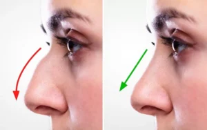 Recovery and Results from Preservation Rhinoplasty in Dubai